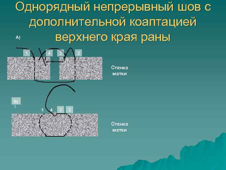 Однорядный непрерывный шов с дополнительной коаптацией верхнего края раны А) 1 4 3 2