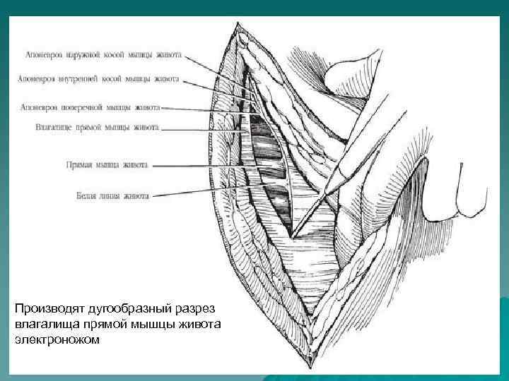 Производят дугообразный разрез влагалища прямой мышцы живота электроножом 
