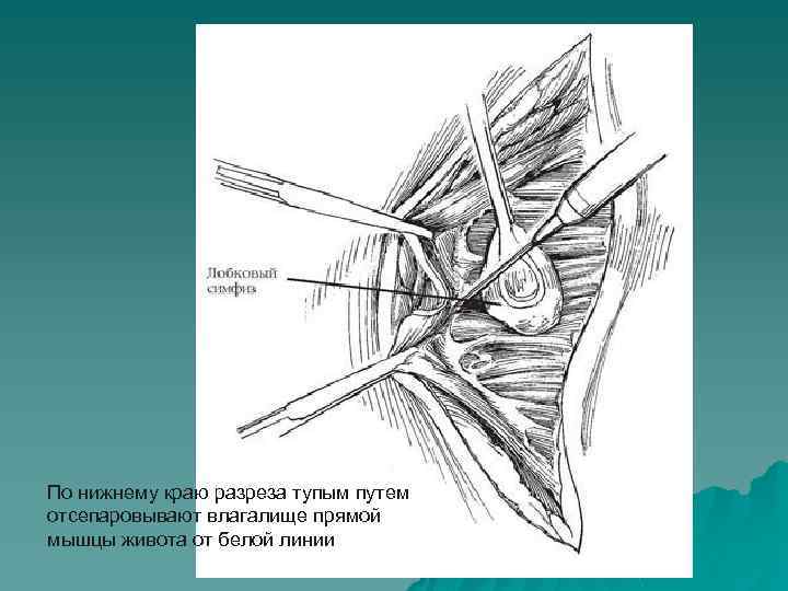 По нижнему краю разреза тупым путем отсепаровывают влагалище прямой мышцы живота от белой линии