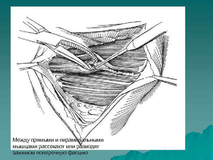 Между прямыми и пирамидальными мышцами рассекают или разводят зажимом поперечную фасцию 