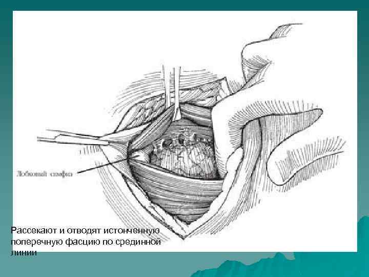 Рассекают и отводят истонченную поперечную фасцию по срединной линии 