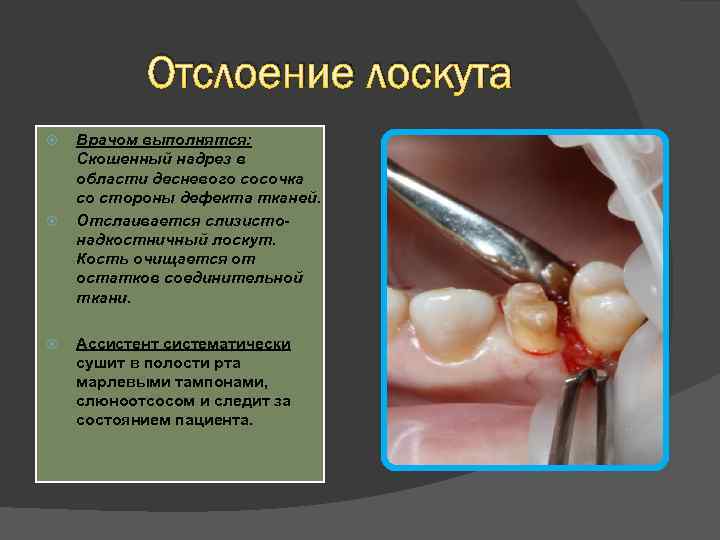 Отслоение лоскута Врачом выполнятся: Скошенный надрез в области десневого сосочка со стороны дефекта тканей.