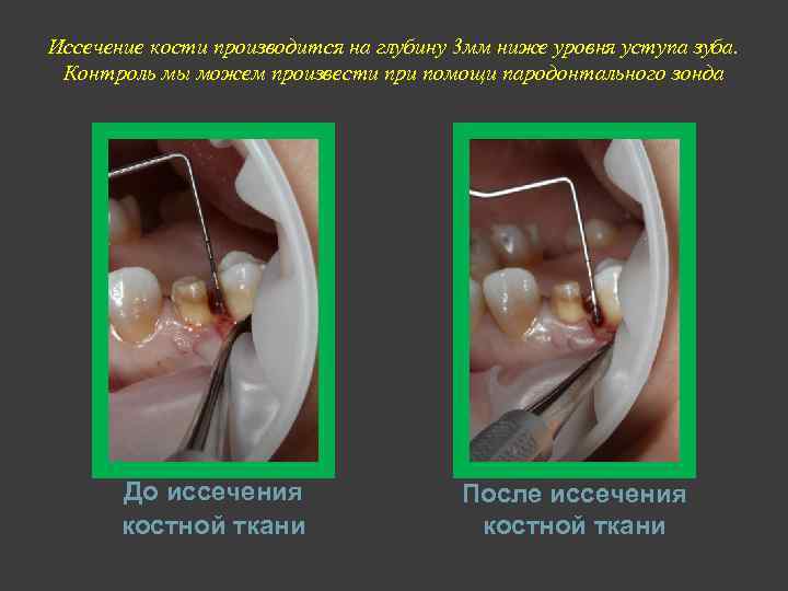 Иссечение кости производится на глубину 3 мм ниже уровня уступа зуба. Контроль мы можем