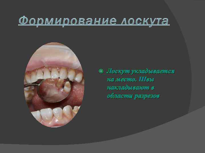  Лоскут укладывается на место. Швы накладывают в области разрезов 