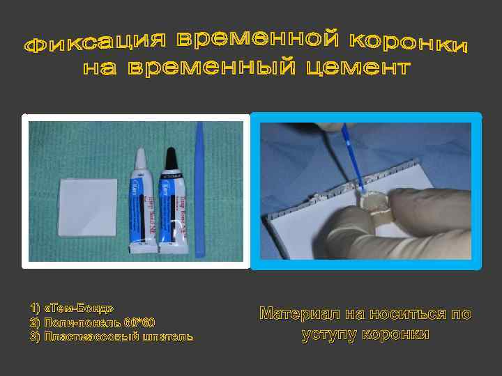 1) «Тем-Бонд» 2) Поли-понель 60*60 3) Пластмассовый шпатель Материал на носиться по уступу коронки