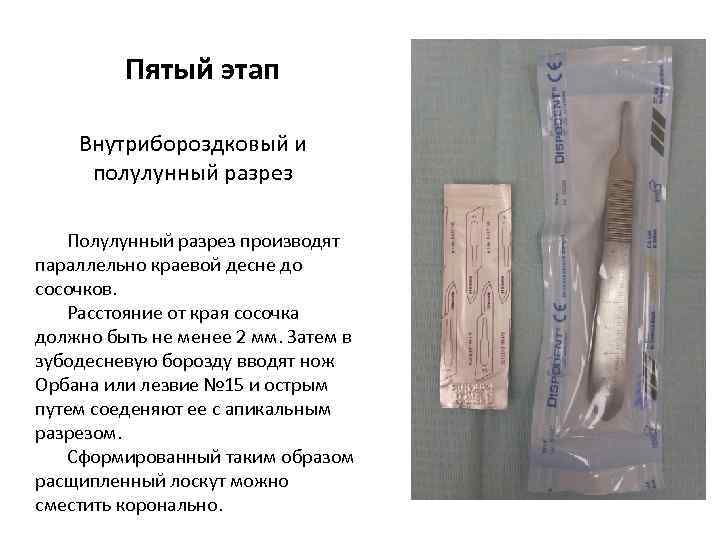 Пятый этап Внутрибороздковый и полулунный разрез Полулунный разрез производят параллельно краевой десне до сосочков.