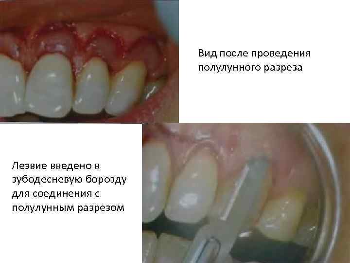 Вид после проведения полулунного разреза Лезвие введено в зубодесневую борозду для соединения с полулунным
