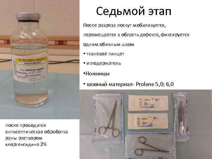 Седьмой этап После разреза лоскут мобилизуется, перемещается в область дефекта, фиксируется одним обивным швом
