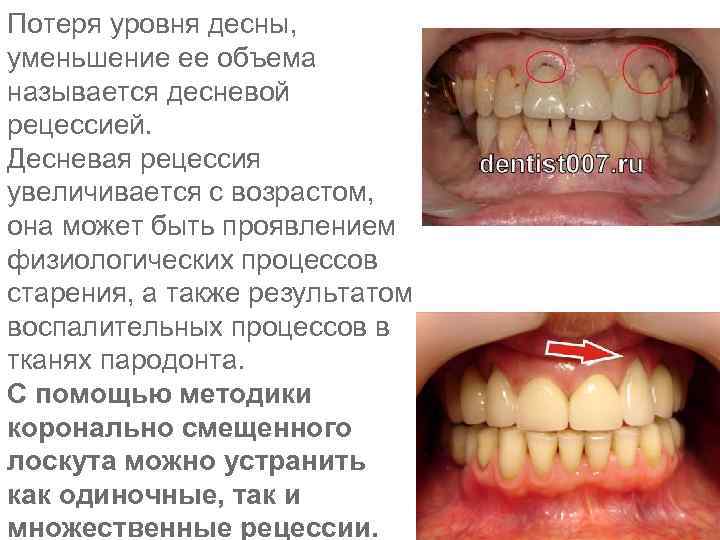 Потеря уровня десны, уменьшение ее объема называется десневой рецессией. Десневая рецессия увеличивается с возрастом,