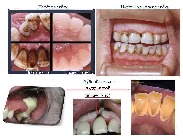 Налёт на зубах. До гигиены Налёт + камень на зубах. После гигиены Зубной камень: