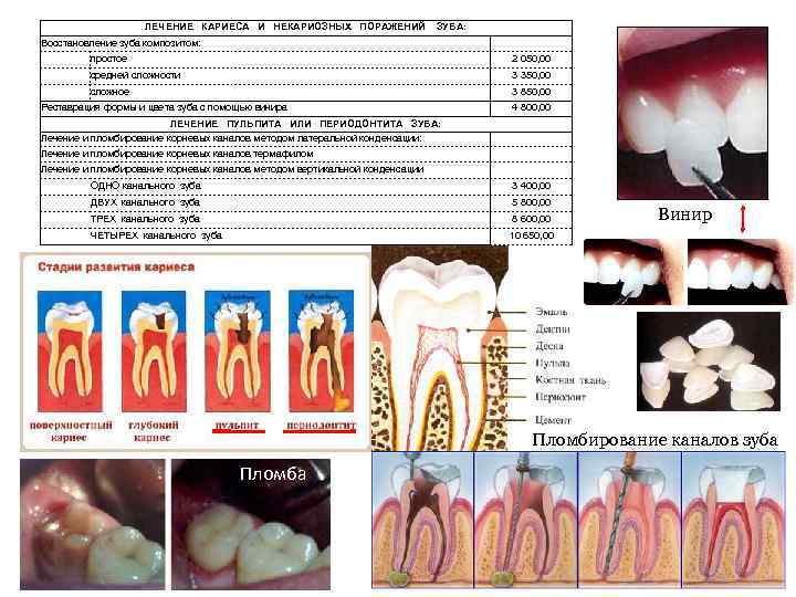 План лечения кариеса