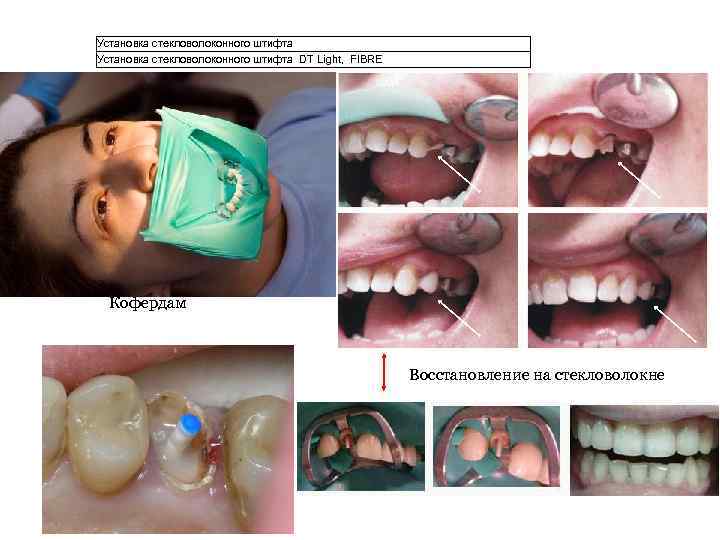 Установка стекловолоконного штифта DT Light, FIBRE Кофердам Восстановление на стекловолокне 