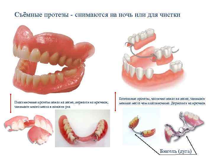 Съёмные протезы - снимаются на ночь или для чистки Пластиночные протезы лежат на десне,