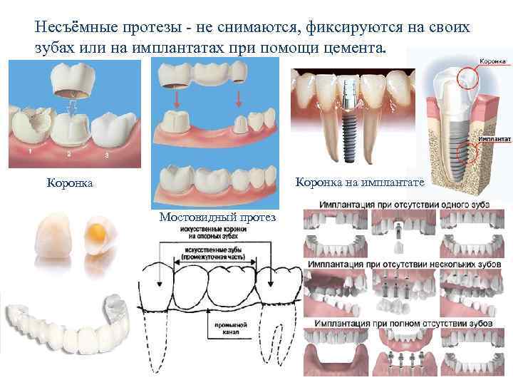 Способы индивидуализации несъемных реставраций зубов презентация