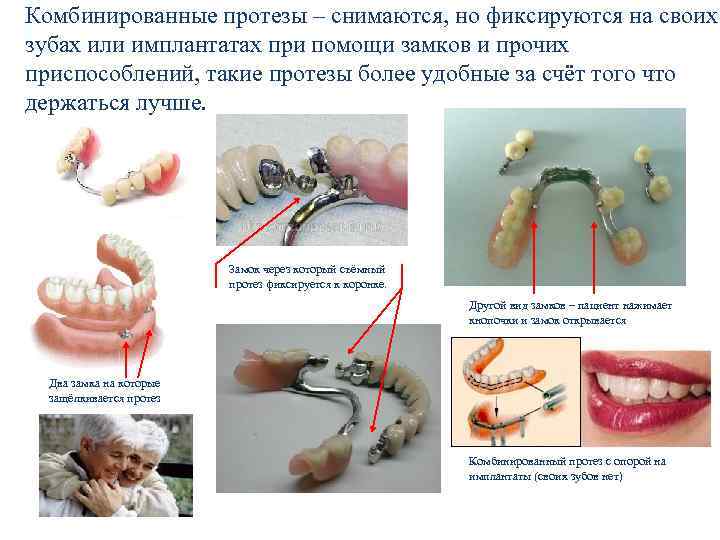 Комбинированные протезы – снимаются, но фиксируются на своих зубах или имплантатах при помощи замков