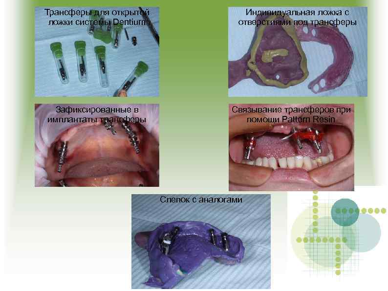 Трансферы для открытой ложки системы Dentium Зафиксированные в имплантаты трансферы Индивидуальная ложка с отверстиями