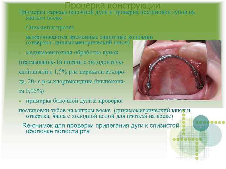 Проверка конструкции Примерка каркаса балочной дуги и проверка постановки зубов на мягком воске Снимается