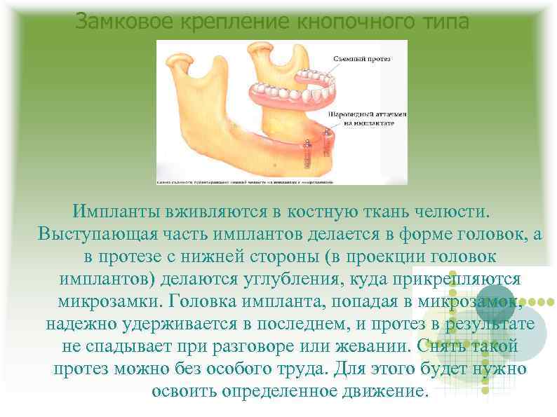 Замковое крепление кнопочного типа Импланты вживляются в костную ткань челюсти. Выступающая часть имплантов делается