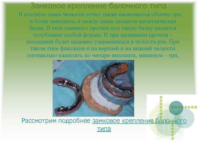 Замковое крепление балочного типа В костную ткань челюсти точно также вживляются обычно три и