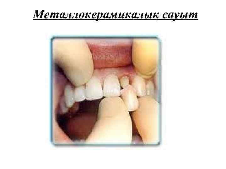 Металлокерамикалық сауыт 