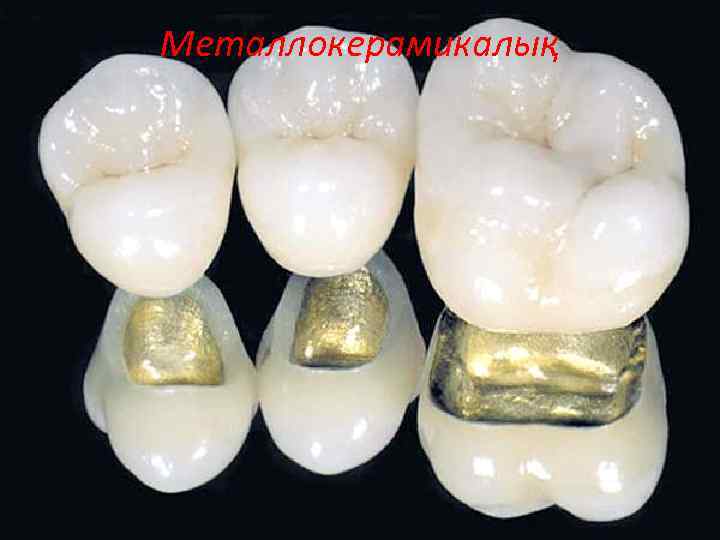 Металлокерамикалық 