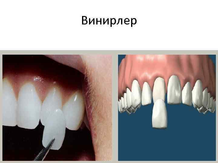 Винирлер 