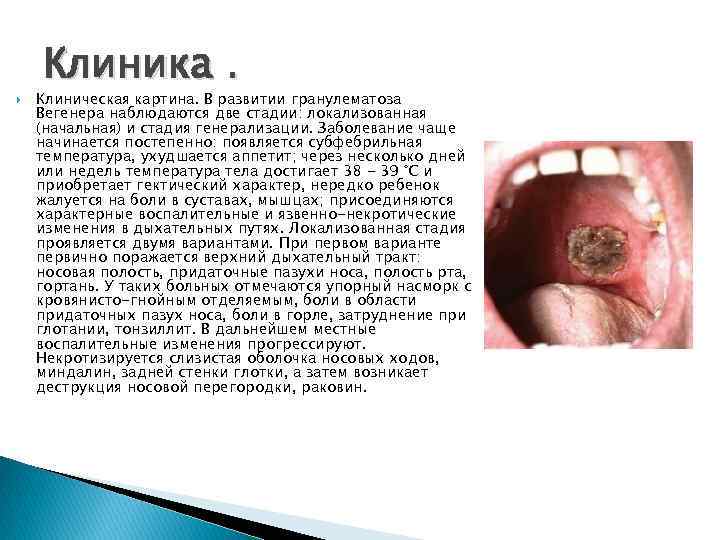  Клиника. Клиническая картина. В развитии гранулематоза Вегенера наблюдаются две стадии: локализованная (начальная) и