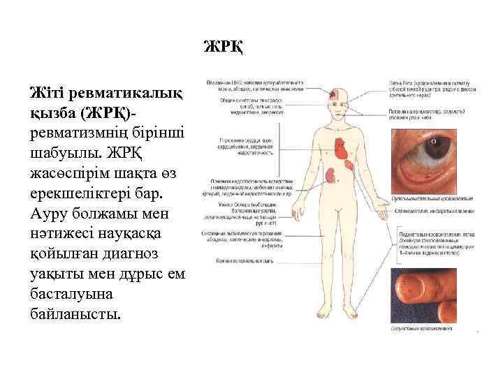 ЖРҚ Жіті ревматикалық қызба (ЖРҚ)ревматизмнің бірінші шабуылы. ЖРҚ жасөспірім шақта өз ерекшеліктері бар. Ауру