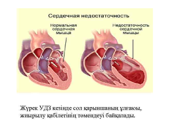 Жүрек УДЗ кезінде сол қарыншаның ұлғаюы, жиырылу қабілетінің төмендеуі байқалады. 