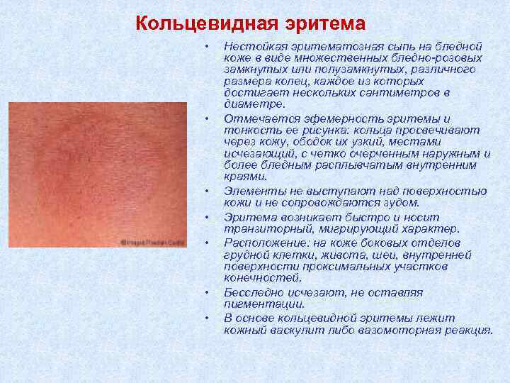 Кольцевидная эритема • • Нестойкая эритематозная сыпь на бледной коже в виде множественных бледно-розовых