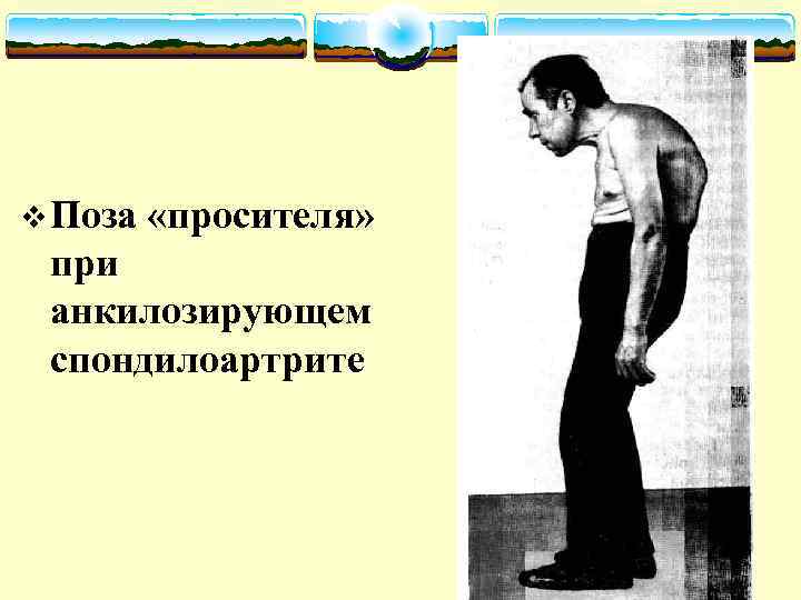 v Поза «просителя» при анкилозирующем спондилоартрите 