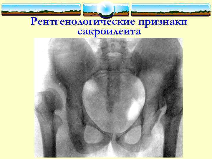 Рентгенологические признаки сакроилеита 