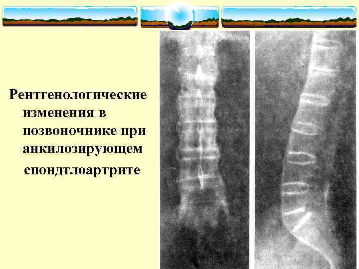 Рентгенологические изменения в позвоночнике при анкилозирующем спондтлоартрите 