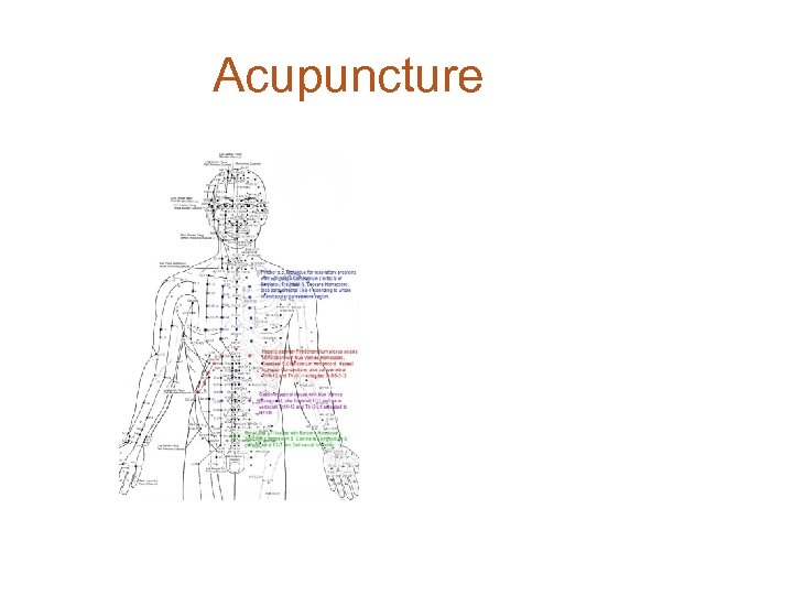 Acupuncture 