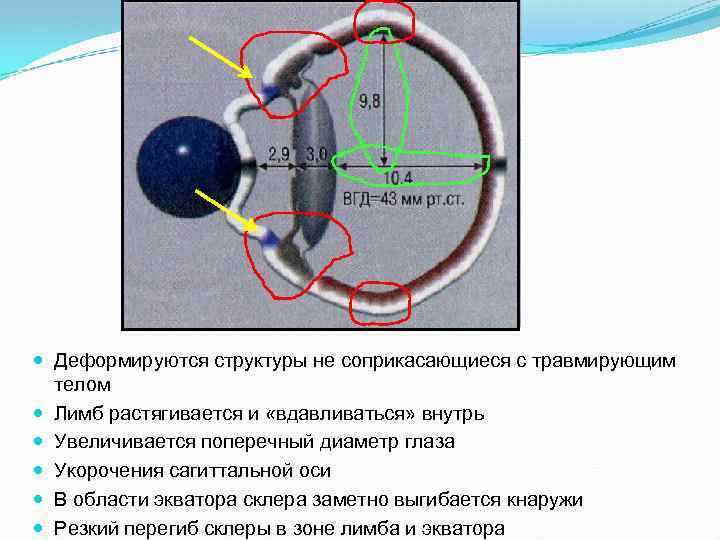  Деформируются структуры не соприкасающиеся с травмирующим телом Лимб растягивается и «вдавливаться» внутрь Увеличивается