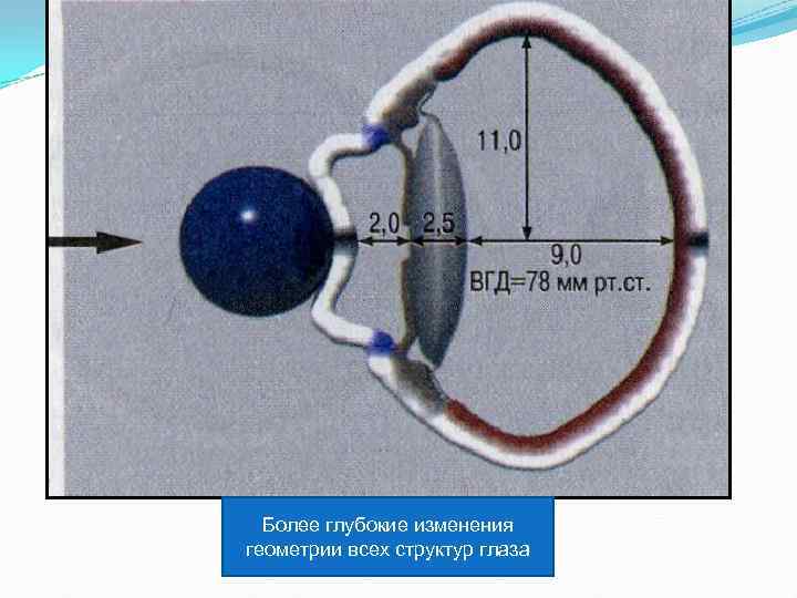 Более глубокие изменения геометрии всех структур глаза 