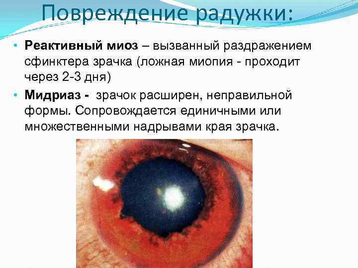 Повреждение радужки: • Реактивный миоз – вызванный раздражением сфинктера зрачка (ложная миопия проходит через