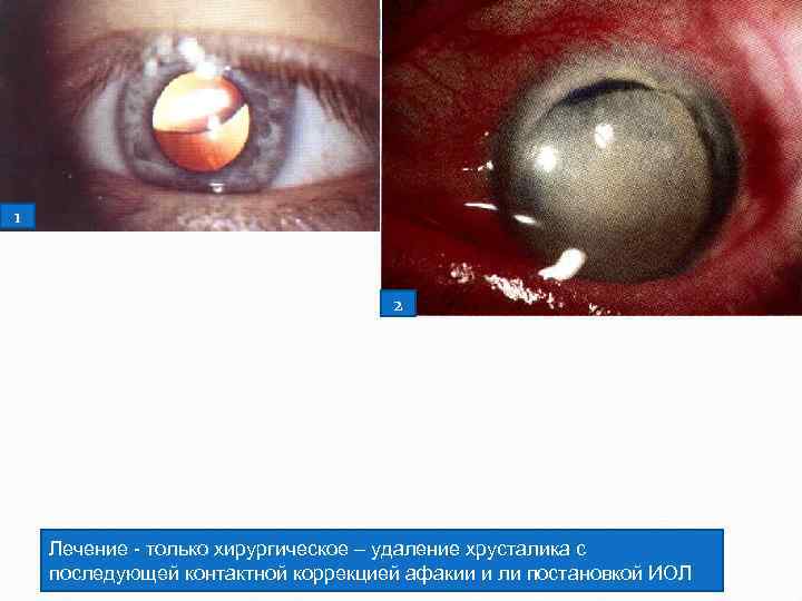 1 2 Лечение только хирургическое – удаление хрусталика с последующей контактной коррекцией афакии и
