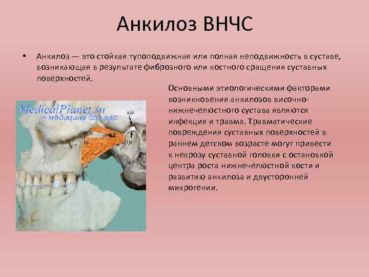 Анкилоз челюсти. Анкилоз височно-нижнечелюстного сустава. Анкилоз ВНЧС этиология.