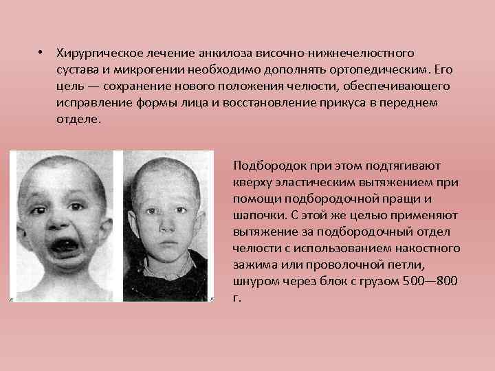  • Хирургическое лечение анкилоза височно-нижнечелюстного сустава и микрогении необходимо дополнять ортопедическим. Его цель