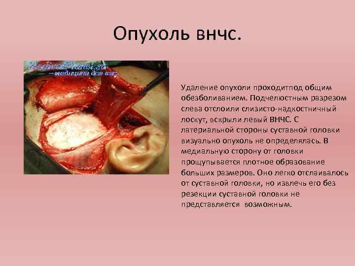 Опухоль внчс. Удаление опухоли проходитпод общим обезболиванием. Подчелюстным разрезом слева отслоили слизисто-надкостничный лоскут, вскрыли