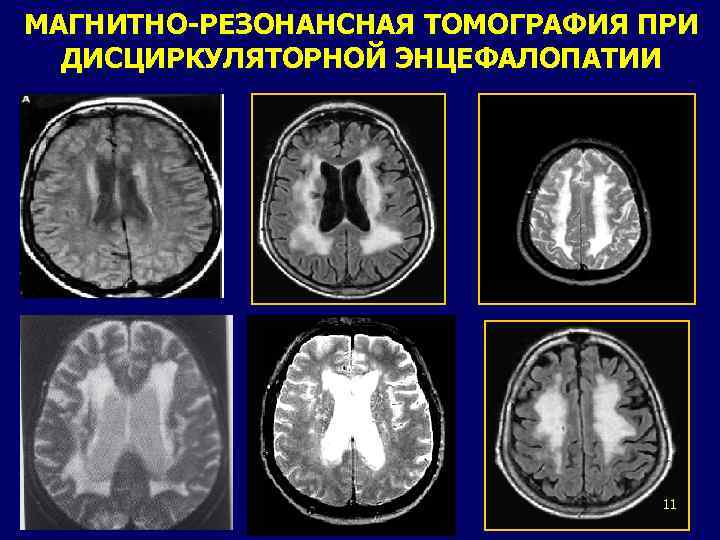МАГНИТНО-РЕЗОНАНСНАЯ ТОМОГРАФИЯ ПРИ ДИСЦИРКУЛЯТОРНОЙ ЭНЦЕФАЛОПАТИИ 11 