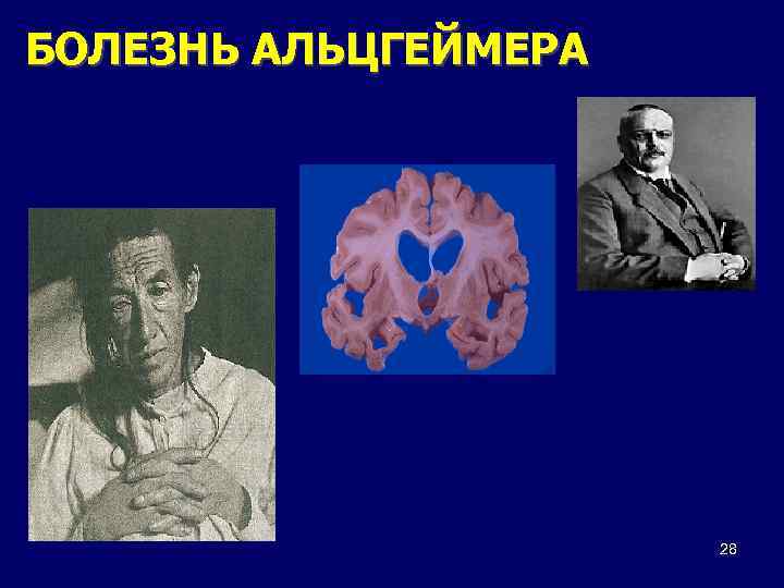 БОЛЕЗНЬ АЛЬЦГЕЙМЕРА 28 