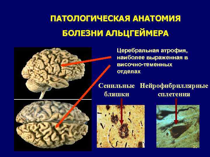 Атрофия мозга симптомы. Дисциркуляторная энцефалопатия анатомия. Патоморфология болезни Альцгеймера. Энцефалопатия патологическая анатомия. Дисциркуляторная энцефалопатия патанатомия.