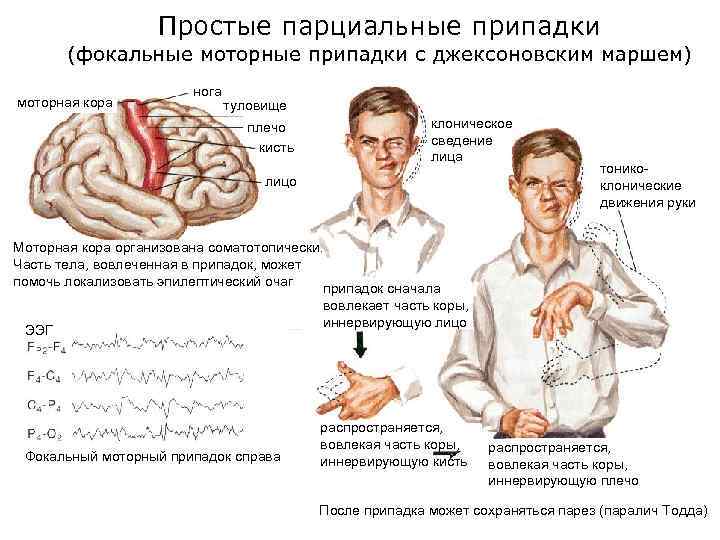 Простые парциальные припадки (фокальные моторные припадки с джексоновским маршем) моторная кора нога туловище плечо