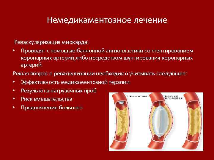 Немедикаментозное лечение Реваскуляризация миокарда: • Проводят с помощью баллонной ангиопластики со стентированием коронарных артерий,