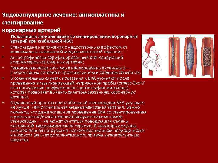 Эндоваскулярное лечение: ангиопластика и стентирование коронарных артерий • • • Показания к ангиопластике со