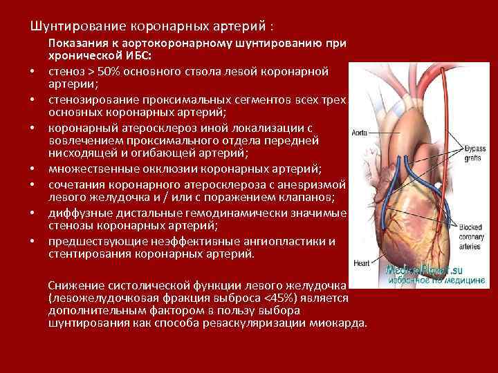 Шунтирование коронарных артерий : Показания к аортокоронарному шунтированию при хронической ИБС: • стеноз >
