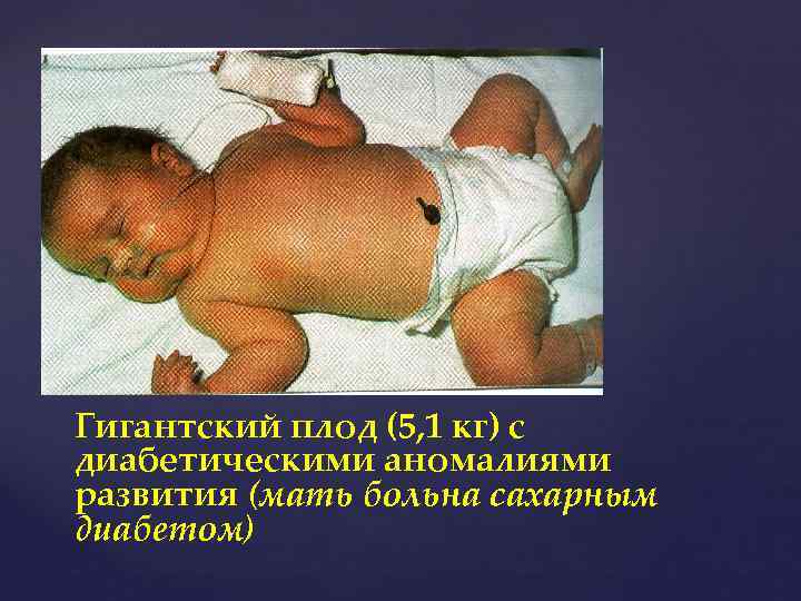 Гигантский плод (5, 1 кг) с диабетическими аномалиями развития (мать больна сахарным диабетом) 