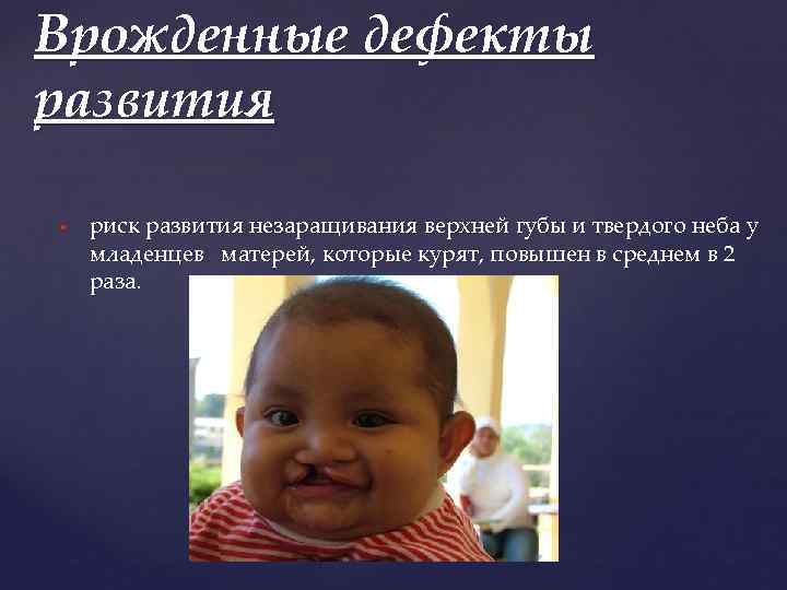 Врожденные дефекты развития риск развития незаращивания верхней губы и твердого неба у младенцев матерей,